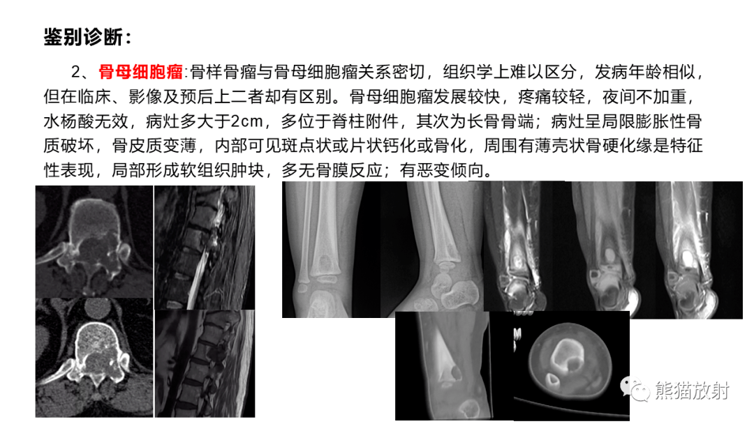 【省立影像读片】下肢骨病变 21.12_内容_骨瘤_骨髓炎