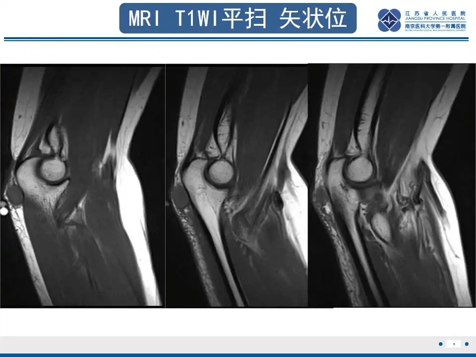 结节性筋膜炎影像表现