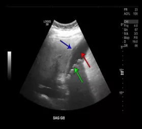 腹部b超提示胆石症伴胆囊内积液,胆囊壁增厚,无明显的胆管扩张(图2)