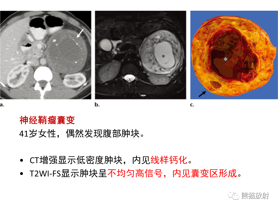 【省立影像读片】腹膜后肿瘤 21.12_内容_副神经_搜索