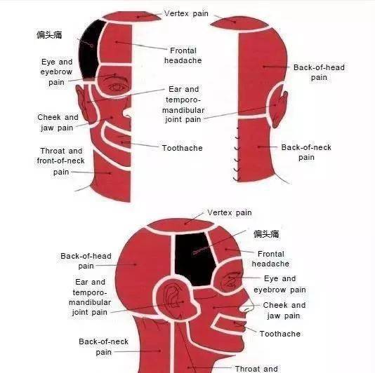 诱发偏头痛的常见肌筋膜触发点及其解剖定位