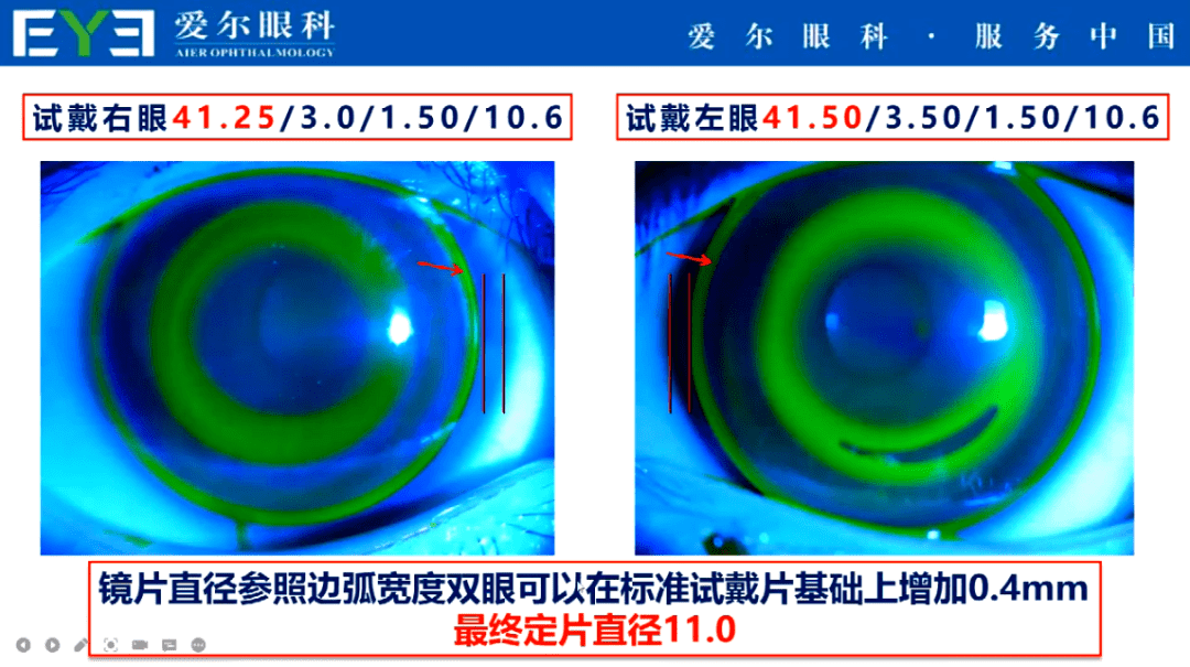 该患者最终定制片的配适效果如下:右眼:由于角膜不对称镜片略有颞偏