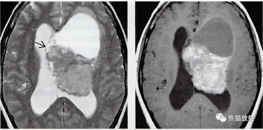 节细胞胶质瘤胚胎发育不良性神经上皮瘤中枢神经细胞瘤丨影像诊断要点