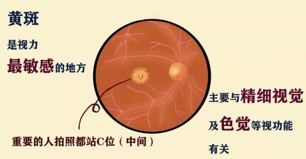 护眼有道高度近视要警惕黄斑病变