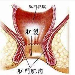 肛裂——痛苦的难言之隐_症状_肛管_裂口