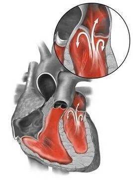 中医科普瓣膜反流说明什么定期复查别忘了