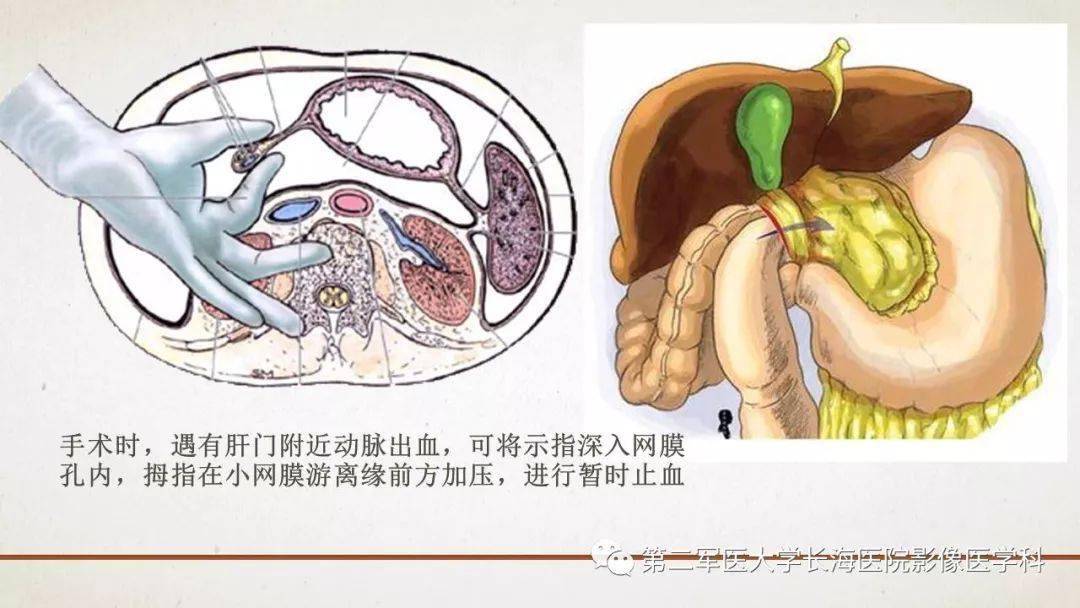 包罗万象的腹膜结构我们真的了解吗影像解剖