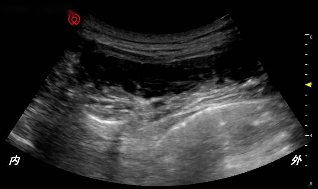 矢状面扫查:探头放置于后正中线上,长轴与脊柱平行,观察低回声的骨性