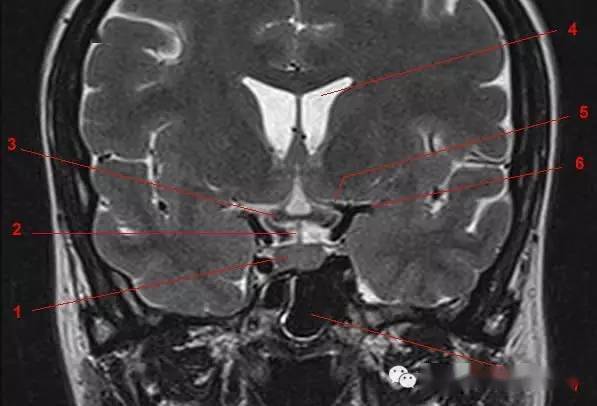 鞍区,垂体磁共振(mri)解剖—冠状面_动脉_大脑_视神经