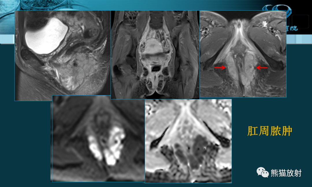 讲座丨盆底解剖与肛周病变的mri表现(蔡世峰教授)_肛管_直肠_肛门