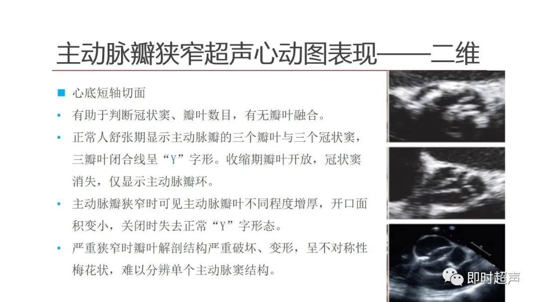 主动脉瓣狭窄及关闭不全