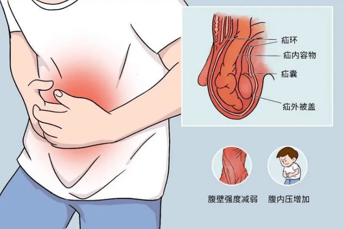 肚子上鼓了个包?别忽视,否则可能后果很严重!_江勇_小超_手术