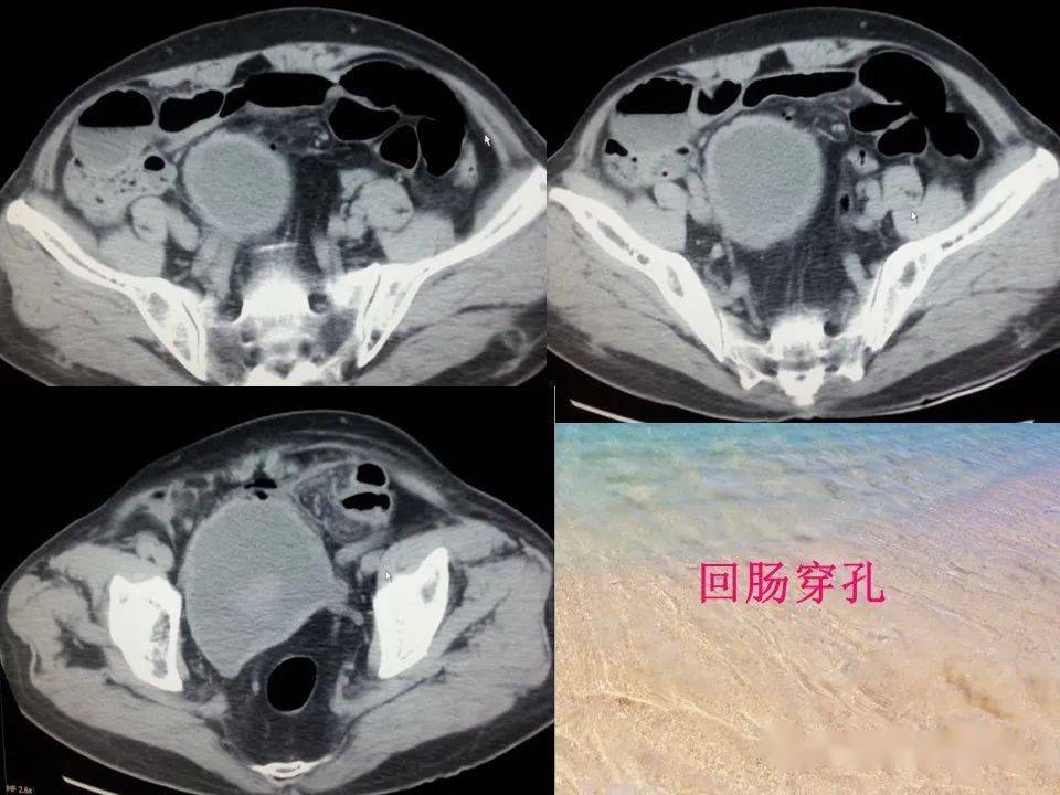 消化道穿孔ct影像大汇总看完印象深刻