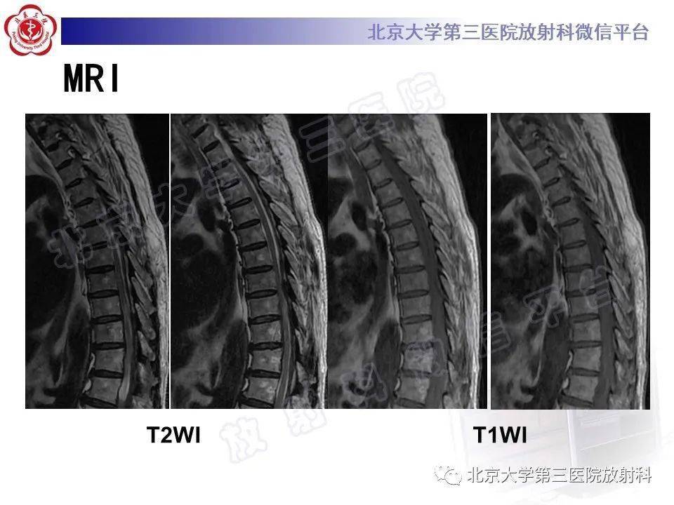 特发性肥厚性硬脊膜炎67ihsp