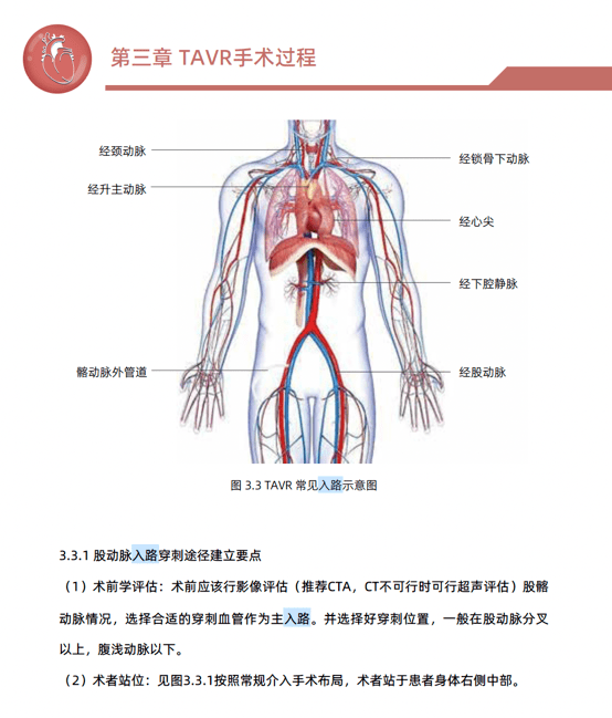 基本分析:三叶瓣,钙化轻,风湿样改变,瓣叶交界区粘连,窦部空间偏小