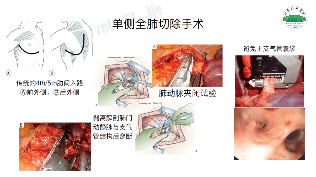 单侧全肺切除术的麻醉管理