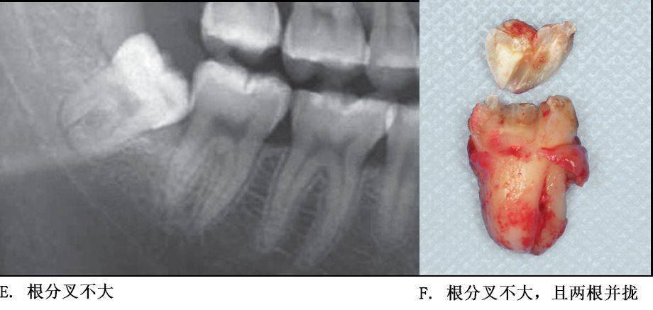 单根牙,根分叉不大者,合并根,融合根,特短根,锥形根阻力较小.