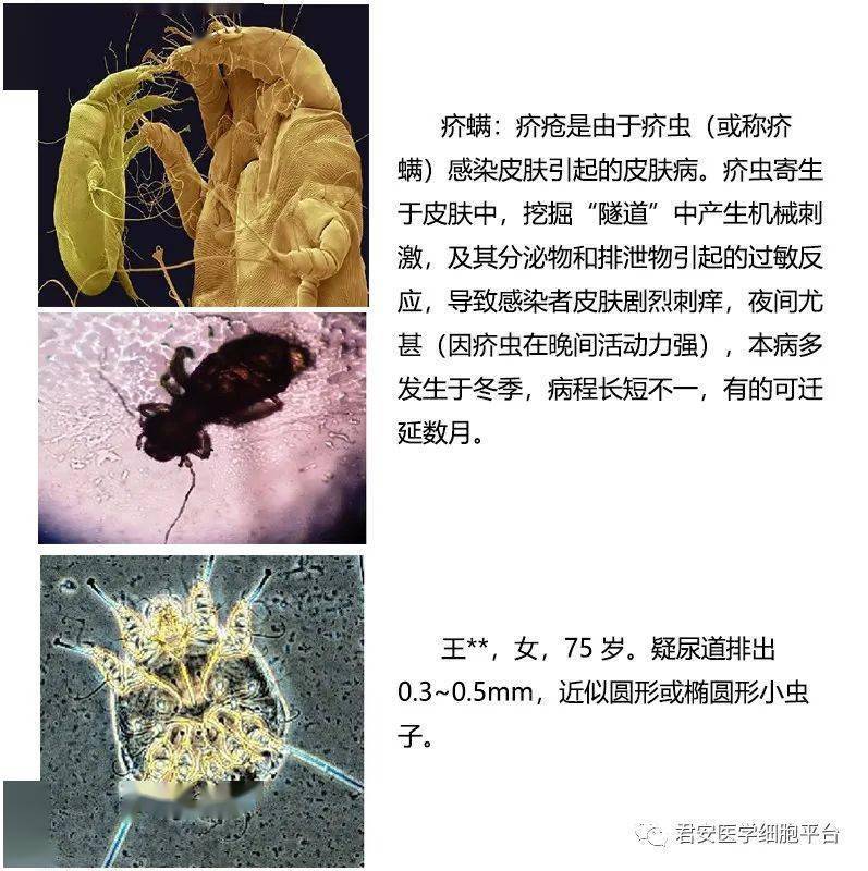 眼睫毛感染寄生虫,虱,螨难寻!_检查_检验_阴虱