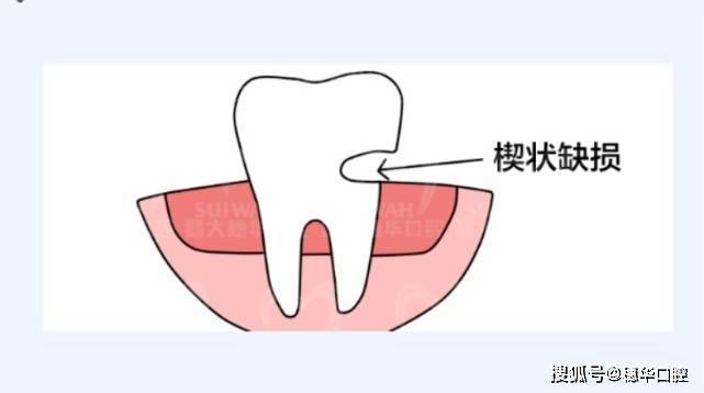 什么是"楔状缺损?