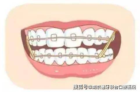 成都生殖助孕机构（【排名公开】南京牙齿矫正医院十大排名_南京牙齿矫正价格）