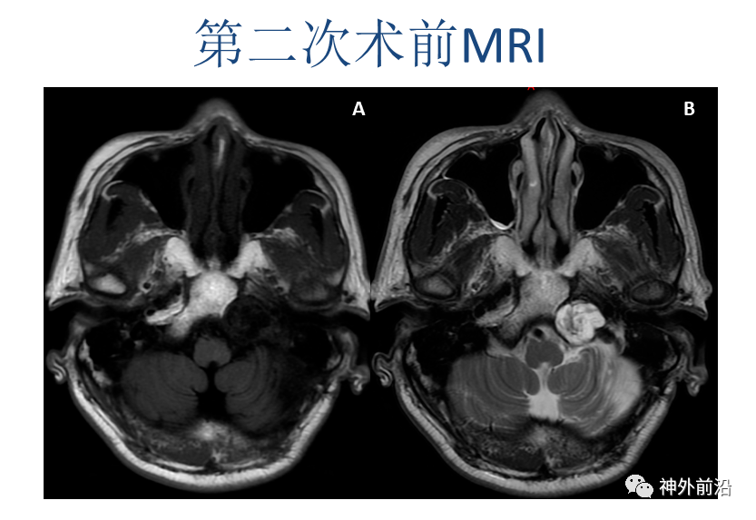 神外前沿:请问听神经瘤手术,在保面的基础上如何保留听力呢?