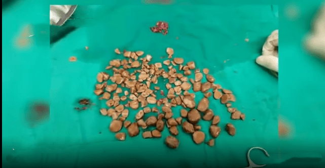 成都供卵费用（密密麻麻！膀胱里竟取出200颗......都是这些坏习惯惹的祸！男性更危险，千万别做这些事）
