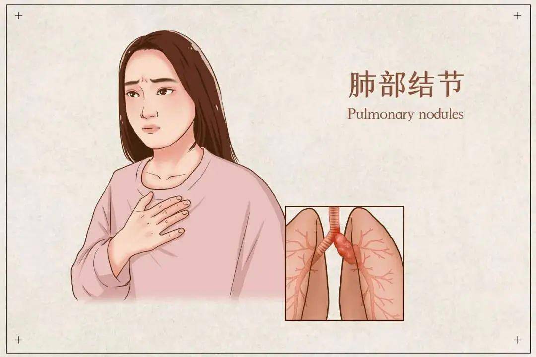 成都借卵生殖中心（查出肺结节莫要慌，中医治疗有妙招！助你改善）