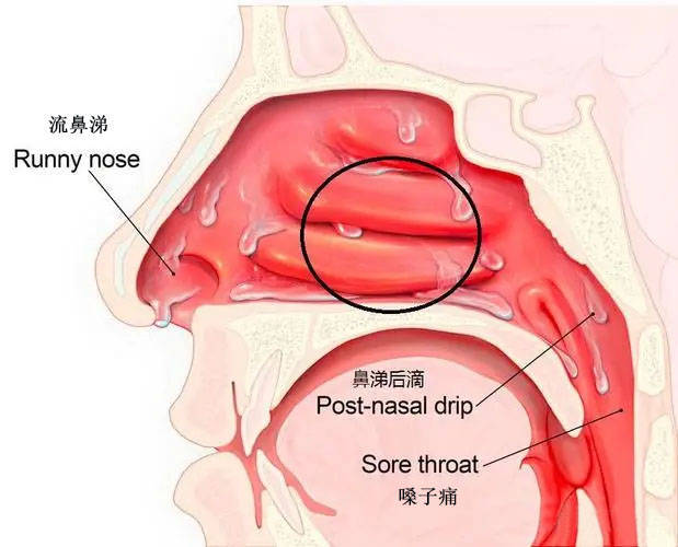 鼻漏 来自搜狐网