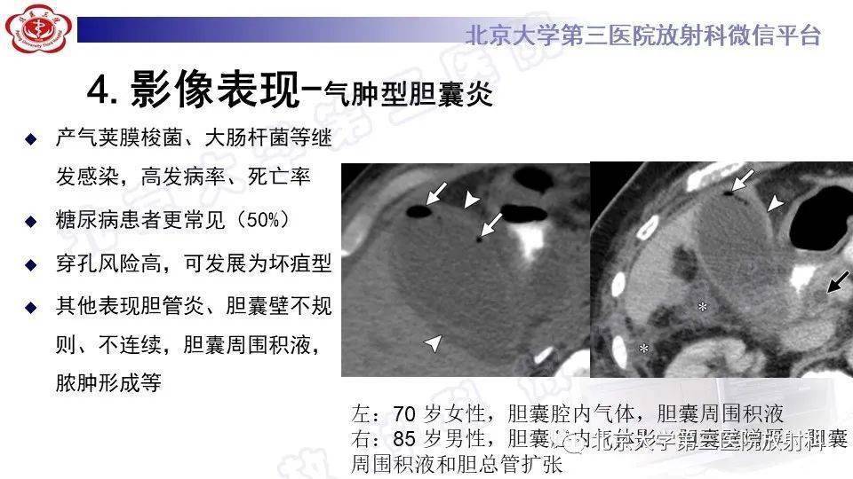 胆囊炎影像诊断