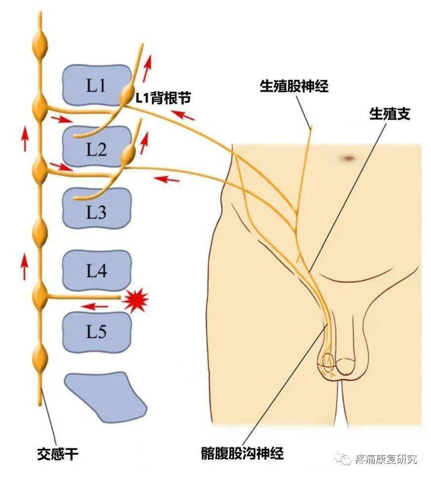 生殖股神经卡压