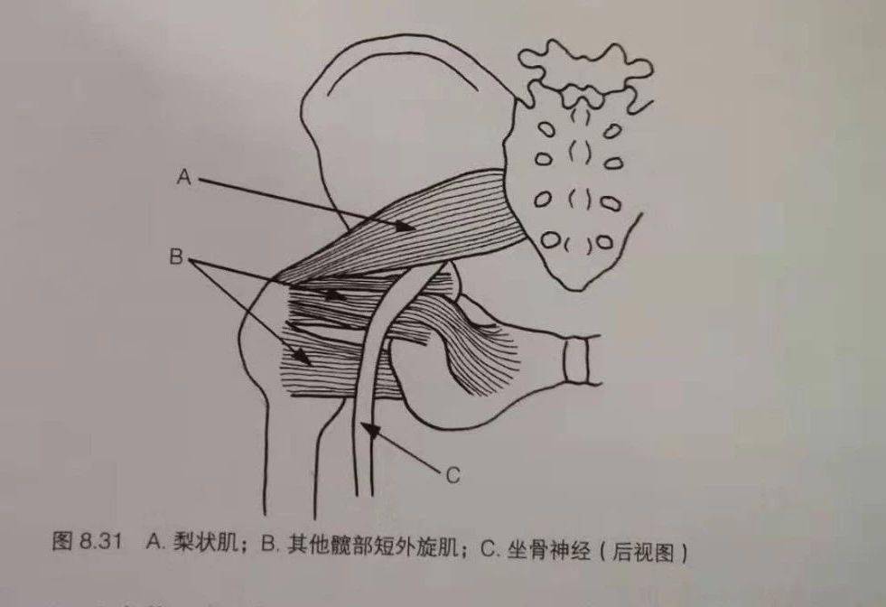 梨状肌综合症解析