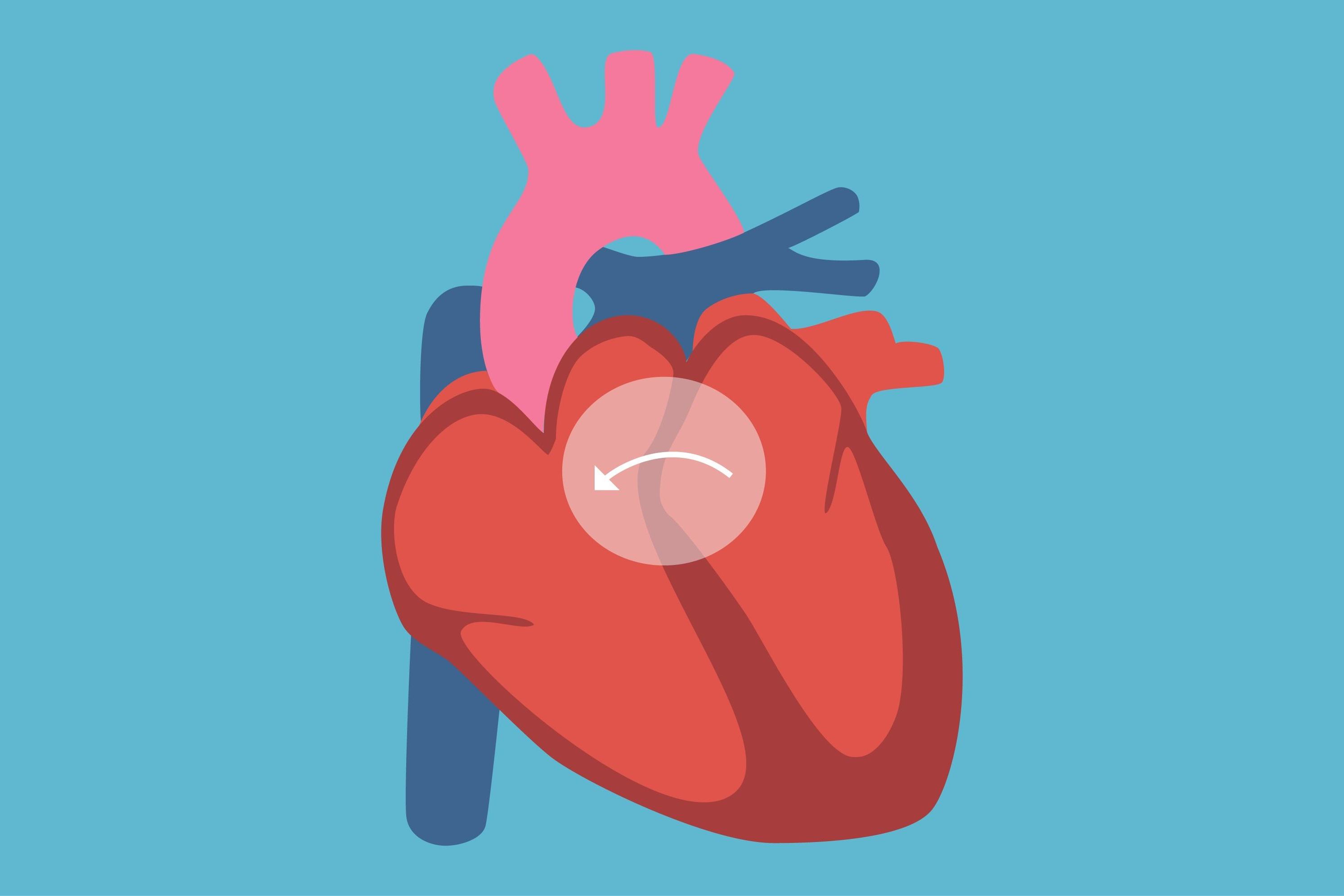 冠心病常年吃西药斑块堵塞八十中医治一个月斑块消