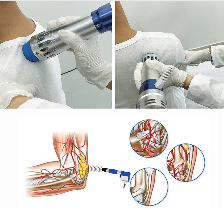 为什么说体外冲击波治疗仪是疼痛的克星