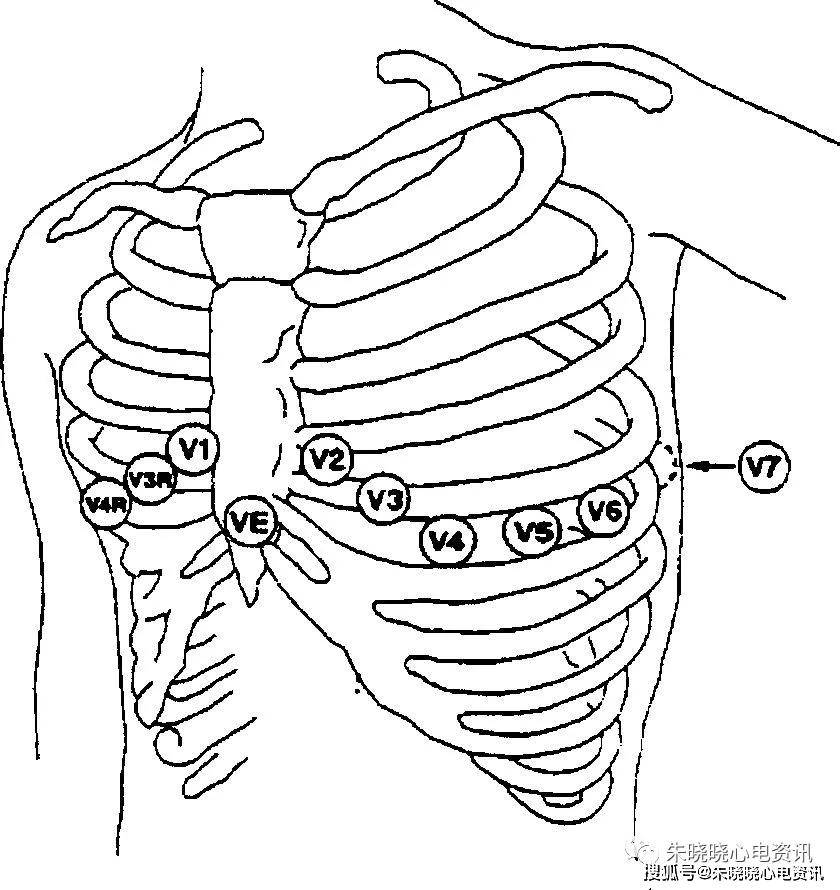 cr1导联 正极置于v1导联处,负极置于右上肢.