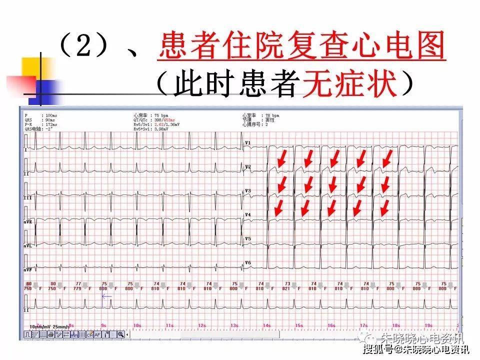谢相屹老师wellens综合征病例的思考ppt