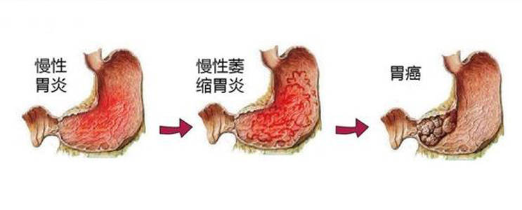 又一年輕明星因胃癌去世胃癌為何頻頻找上年輕人