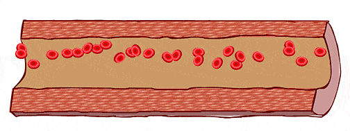 世界预防中风日:河源长安医院预防中风筛查活动,关爱中老年人_动脉