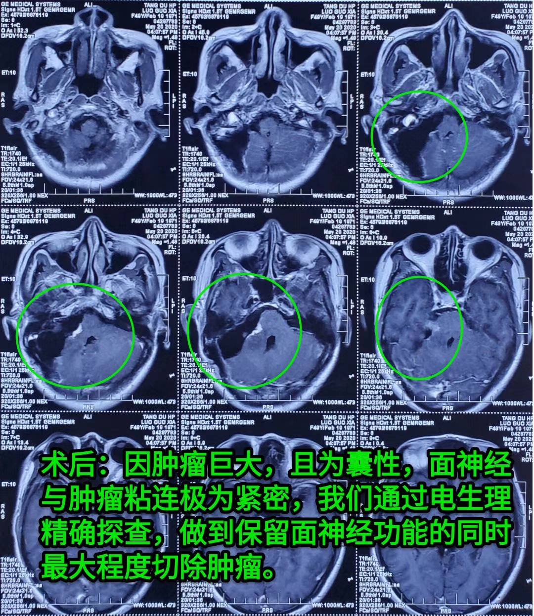 【病例分享】巨大囊性听神经瘤——唐都神经外科赵天智