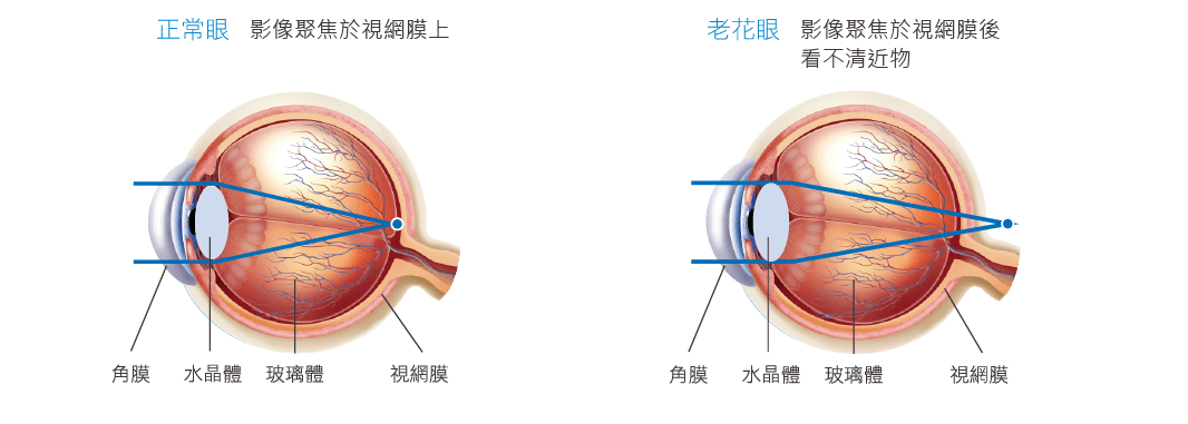 太學眼科教你實用自測分辨白內障,老花眼,眼底病