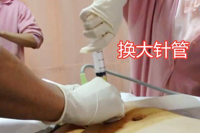 原创准妈妈做羊水穿刺现场老公默默的喊加油而妈妈已哭成泪人