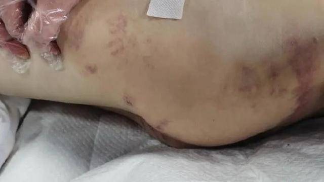 重组家庭残暴后母疑将12岁继女虐待致脑梗死