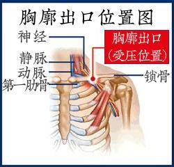 胸部ct增强进一步提示,肿瘤位于锁骨下方,压迫了锁骨下静脉和锁骨下