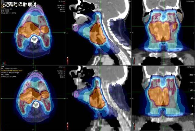 無論加速器的kv級cbct(cone beam ct,錐形束ct),tomo的mvct(mega