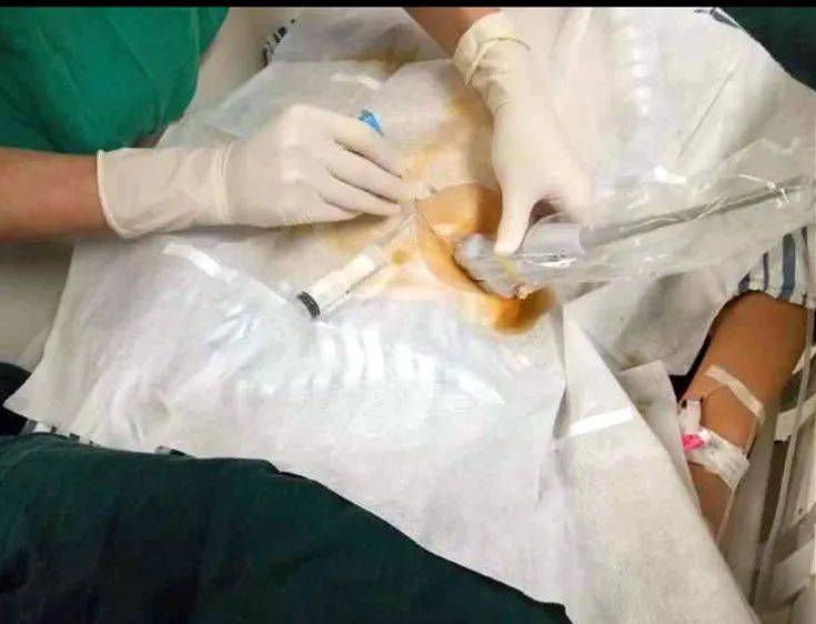 衡水三院麻醉新技术:超声引导下腹横筋膜平面阻滞带你走进" 无痛世界