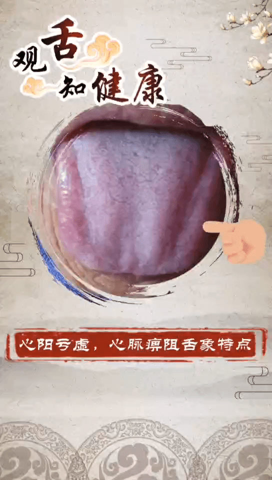 仙方谷心阳亏虚心脉痹阻的舌象特点