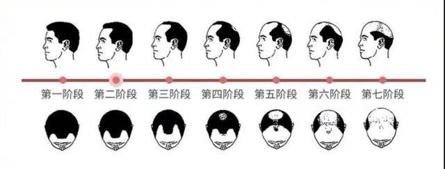 发迹米诺地尔酊:还在为脱发严重,掉头发发愁?