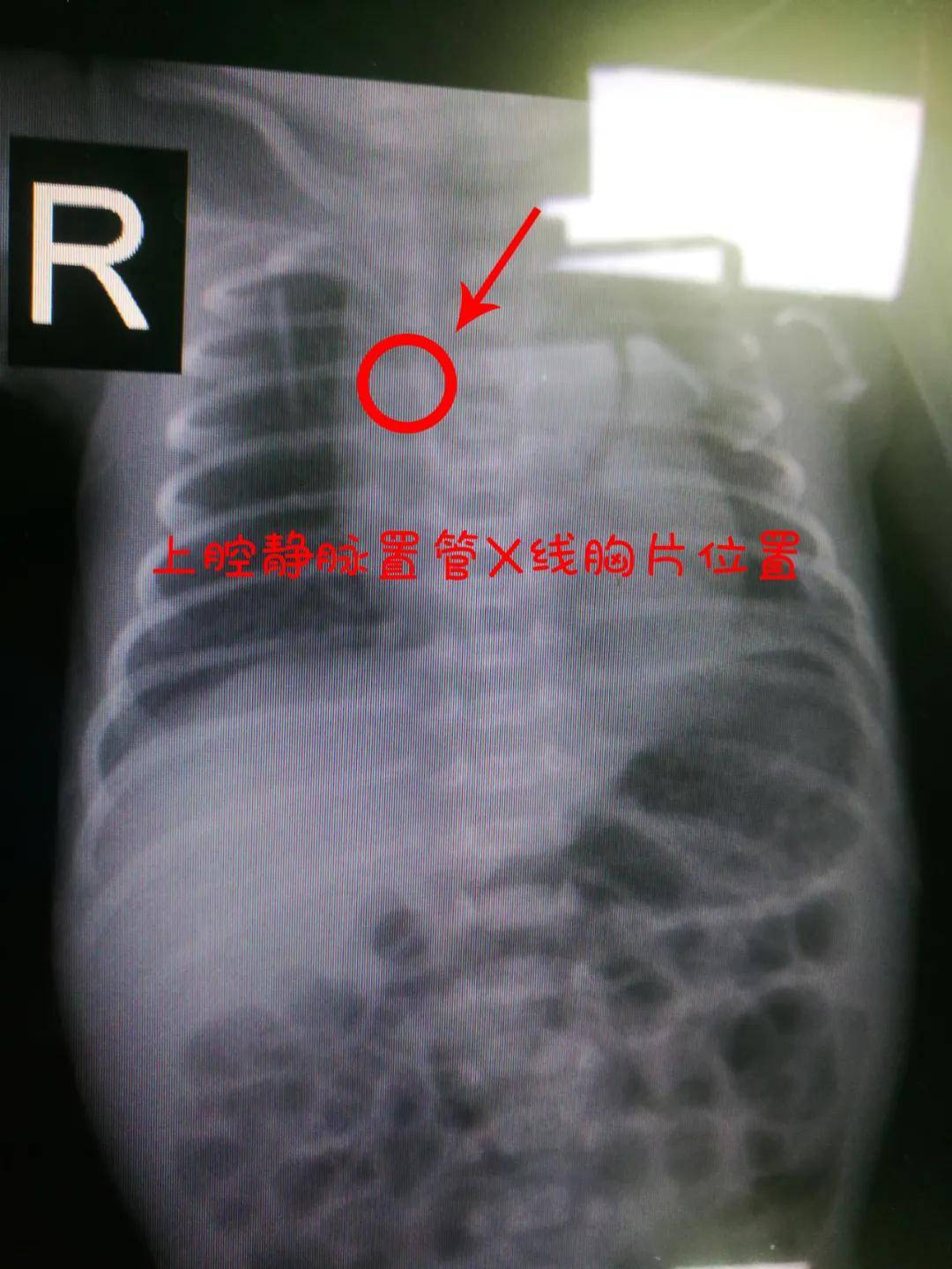 脐静脉置管胸片图片