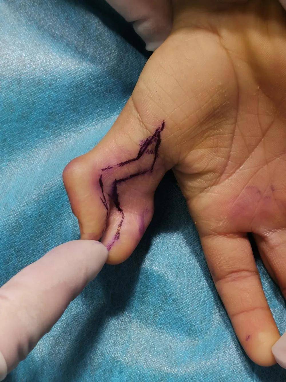 7岁男孩右手像蟹爪,怎么回事?_畸形