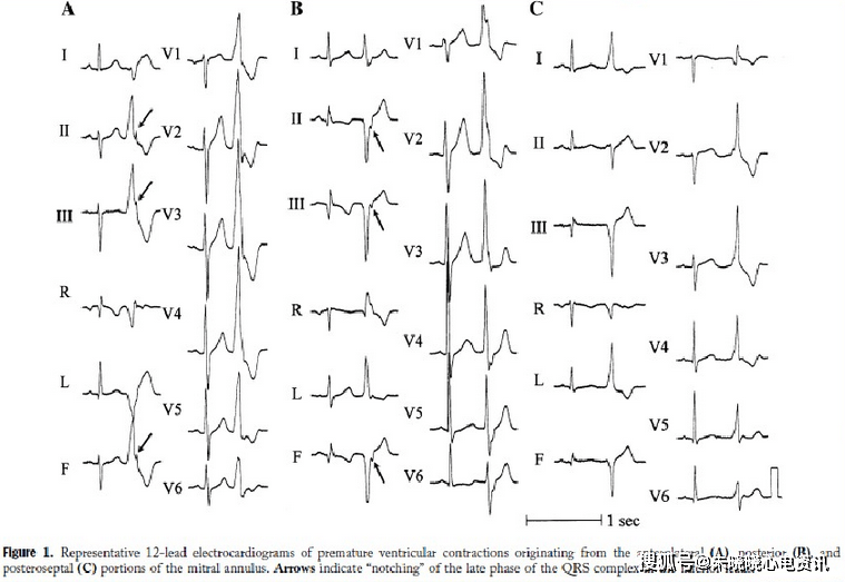室性早搏的心电定位