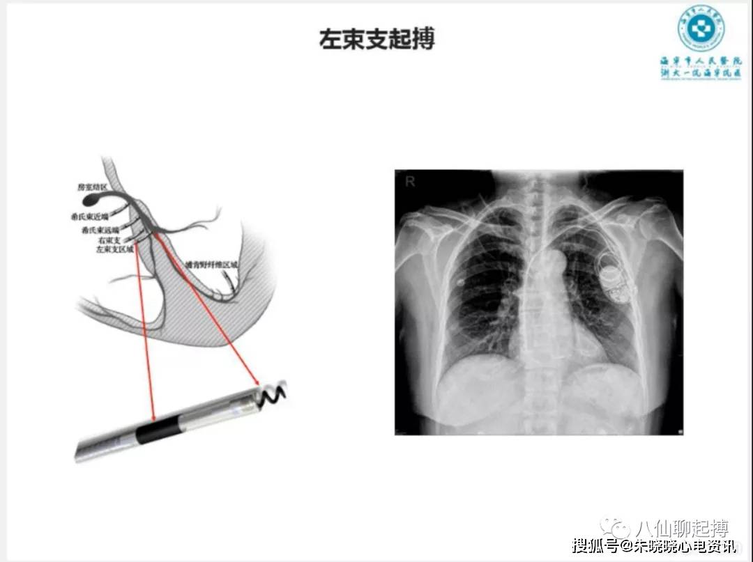 吉亚军老师左束支起搏心电图分析